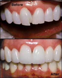 Gingival Pigmentation Removal at Esthetix Dental Spa in Washington Heights, New York