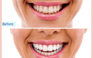 Dental Cleanings