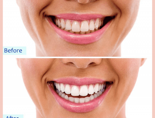 Do Dental Cleanings Hurt?