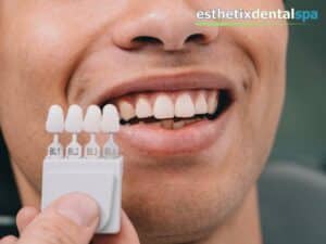 Man comparing tooth shades for Lumineers treatment