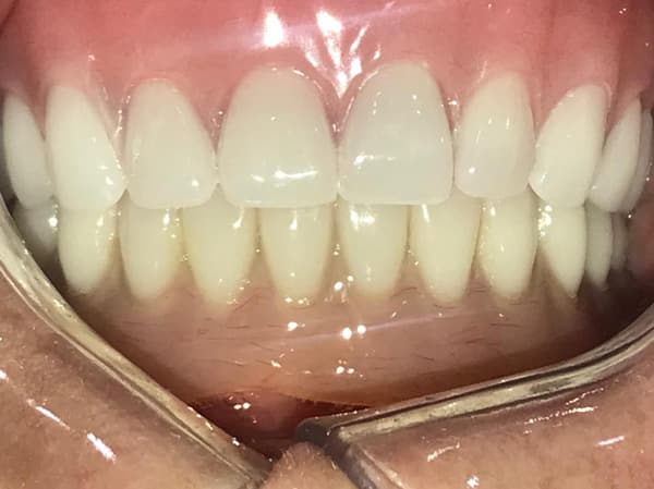 After Dental Implant Procedure done Esthetix Dental Spa