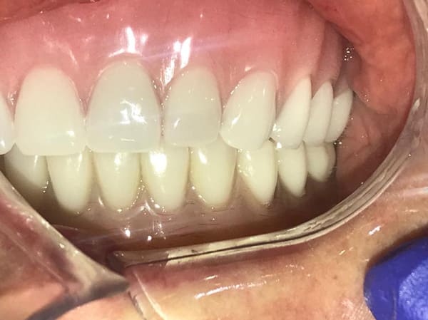 After Dental Implant Procedure done Esthetix Dental Spa