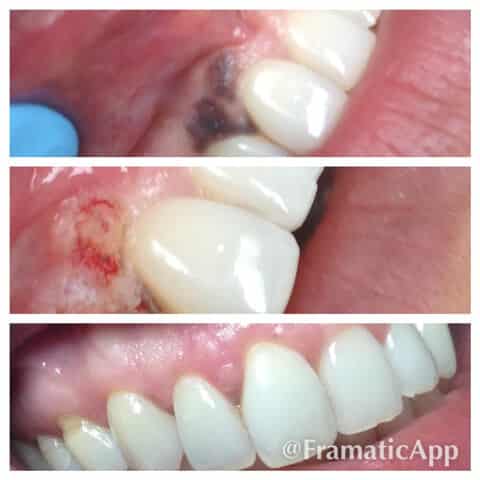 before and after laser treatment to remove the gingival pigmentation done in Esthetix Dental Spa