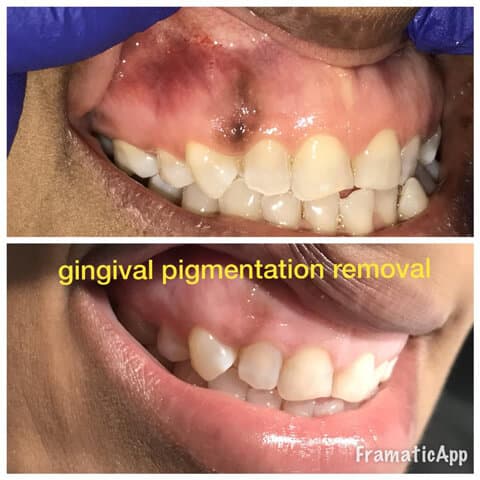 before and after laser treatment to remove the gingival pigmentation done in Esthetix Dental Spa