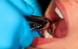 Everything You Need to Know About Tooth Extractions dentist washington heights nyc