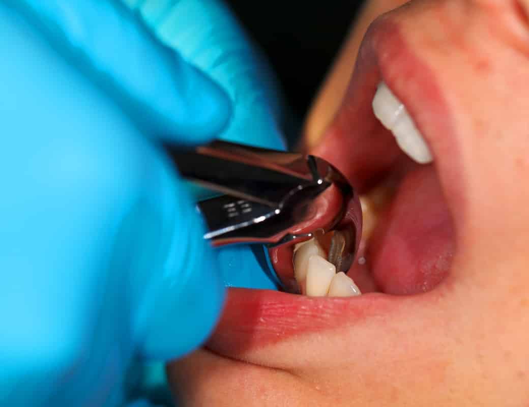 Full Mouth Extraction | Dr. Jasmine Naderi