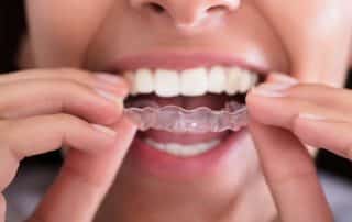 closeup of woman putting invisalign aligner on teeth
