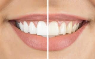 woman smiling before and after teeth whitening treatment