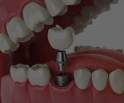 Single Tooth Implant