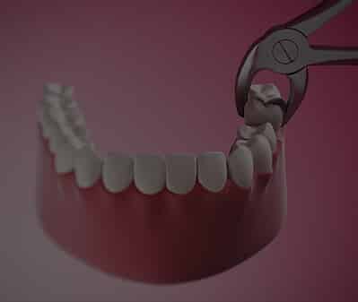 Tooth Extraction