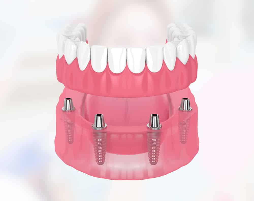 Experts In All On 4 Dental Implants