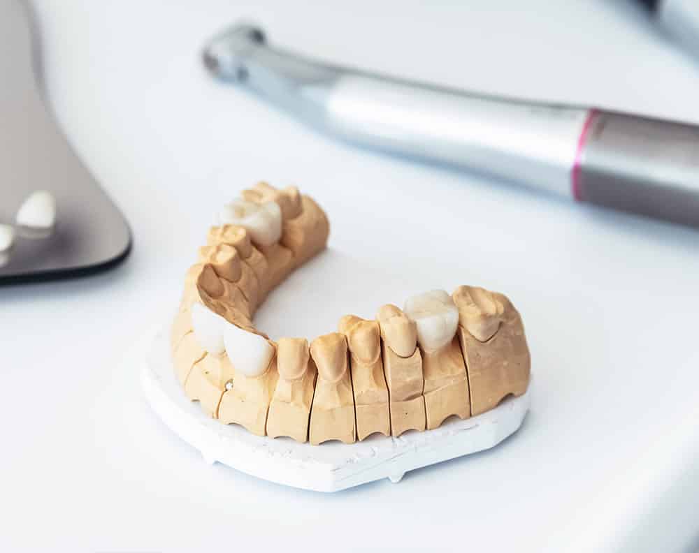 veneers and crowns on dental model