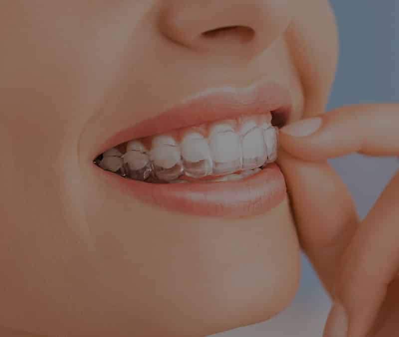 Invisalign