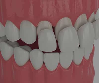 Porcelain Veneers