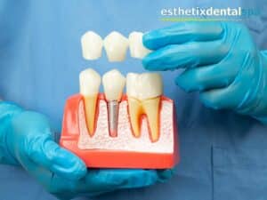 Demonstrating a Dental Bridge model to showcase how it restores missing teeth