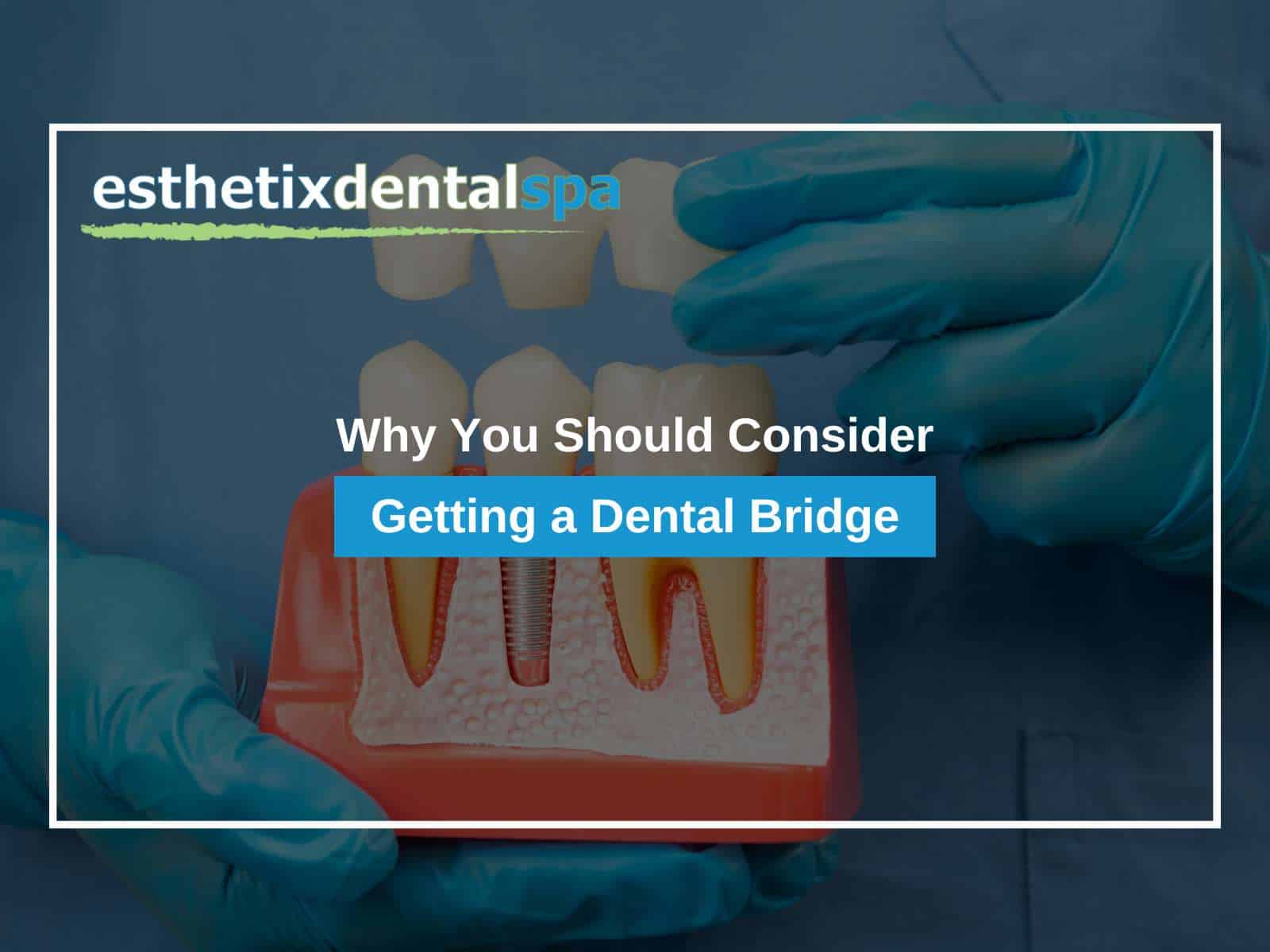 Why You Should Consider Getting a Dental Bridge