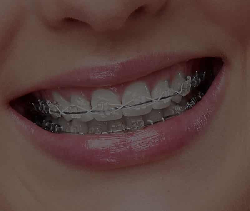 Fast Braces