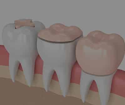 Dental Inlays And Onlays