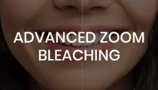 Advanced Zoom Bleaching