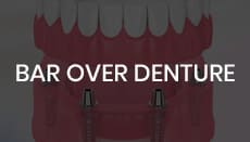 Bar Over Denture