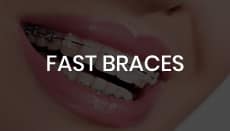 Fast Braces