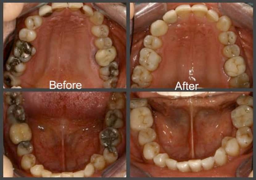 Before and After Dental Inlays & Onlays at Esthetix Dental Spa in Washington Heights, NY