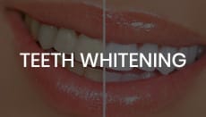 Teeth  Whitening