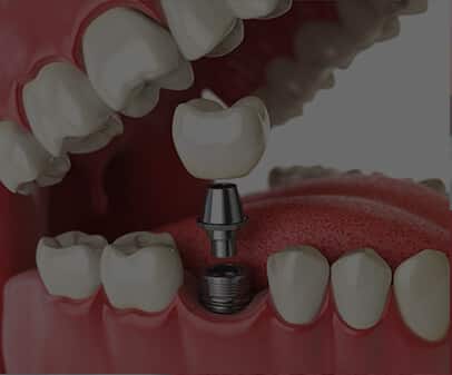 Esthetix Dental Spa Ofrece Servicios De Implantes Dentales En Washington Heights, NY