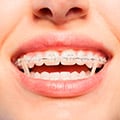 Traditional Braces And Orthodontic Elastics For Correct Teeth Positioning