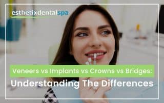 Veneers vs Implants vs Crowns vs Bridges: Understanding The Differences