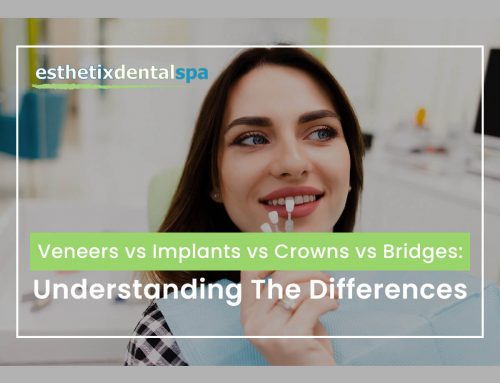 Veneers vs Implants vs Crowns vs Bridges: Understanding The Differences