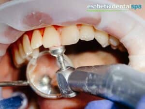 Dental professional polishing teeth during a procedure related to a dental implant