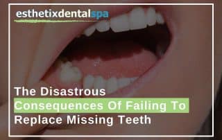 The Disastrous Consequences Of Failing To Replace Missing Teeth