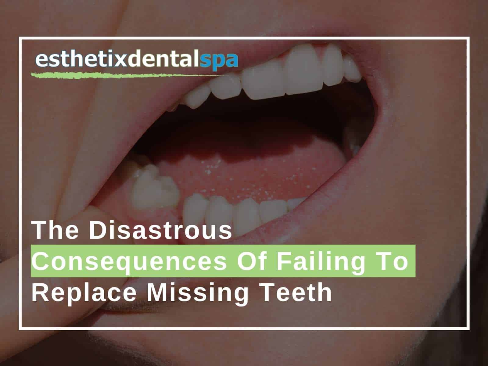 The Disastrous Consequences Of Failing To Replace Missing Teeth