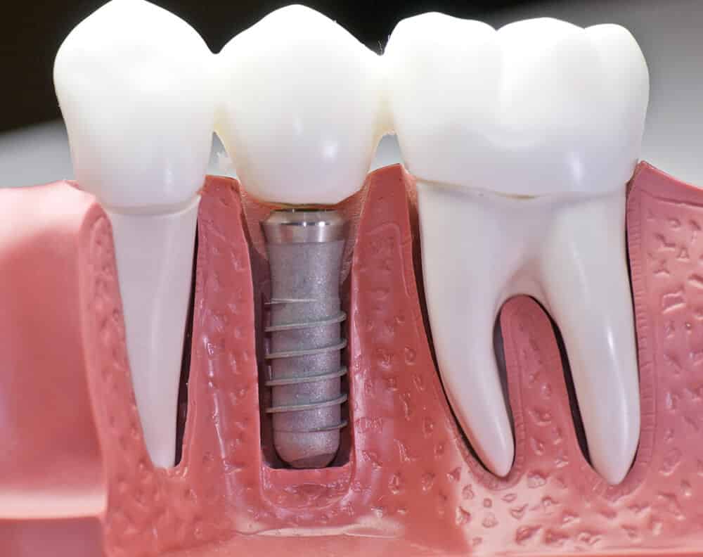 All-On-4 Dental Implant Dentists Near Harlem