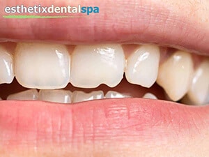 A woman with a chipped tooth in Washington Heights, NY.