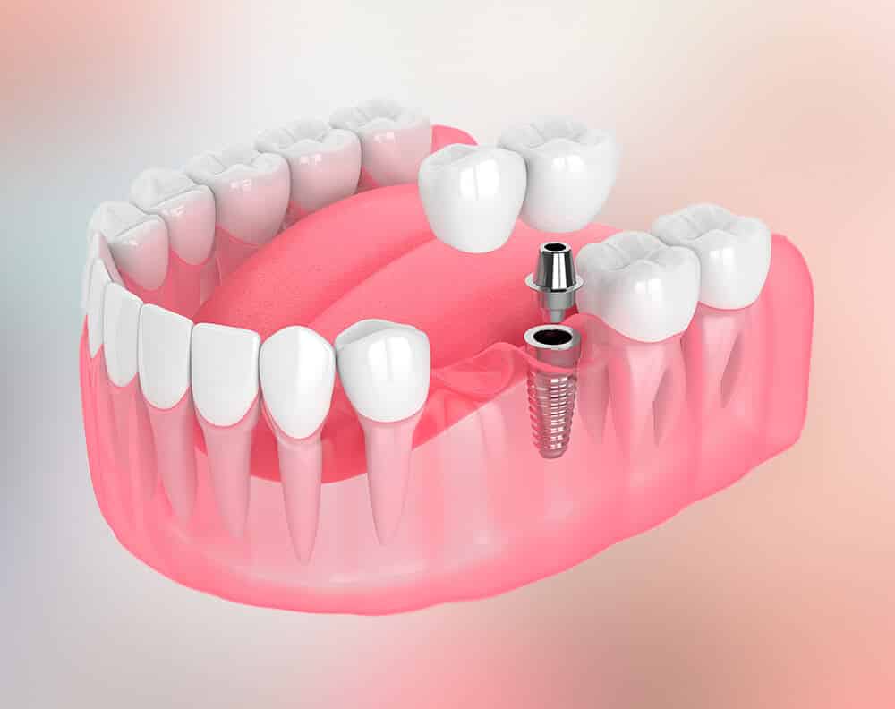Experts In All On 4 Dental Implants Near Sugar Hills
