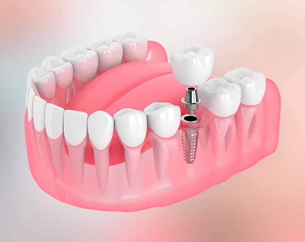 5Star Rated Dental Implants Near The Bronx, NY
