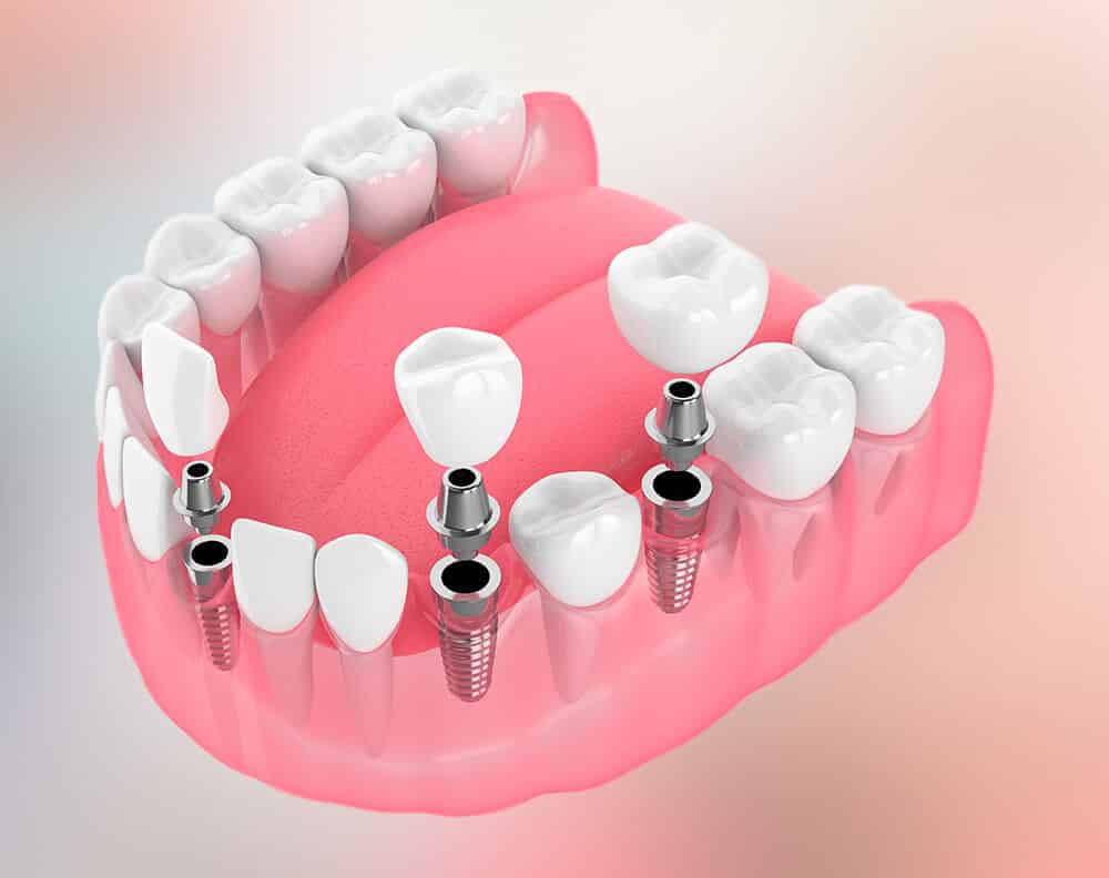 Experts In All On 4 Dental Implants Near Fort George