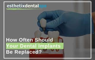 How Often Should Your Dental Implants Be Replaced?
