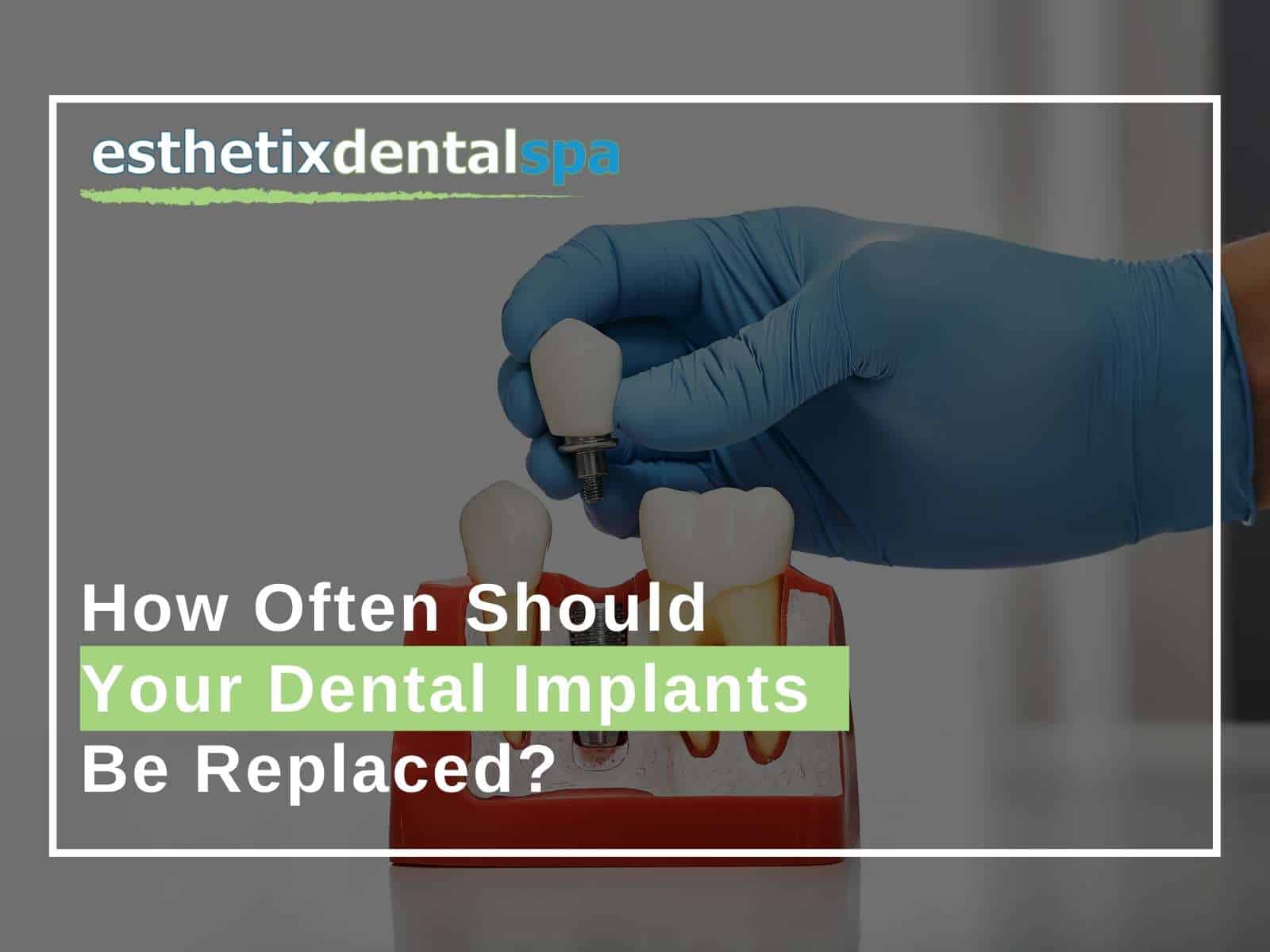 How Often Should Your Dental Implants Be Replaced?