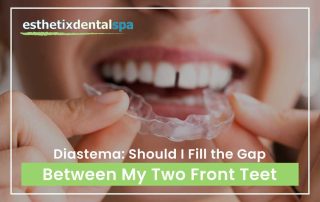 Diastema: Should I Fill The Gap Between My Two Front Teeth