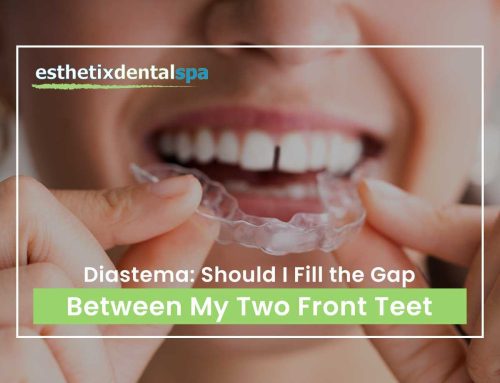 Diastema: Should I Fill The Gap Between My Two Front Teeth
