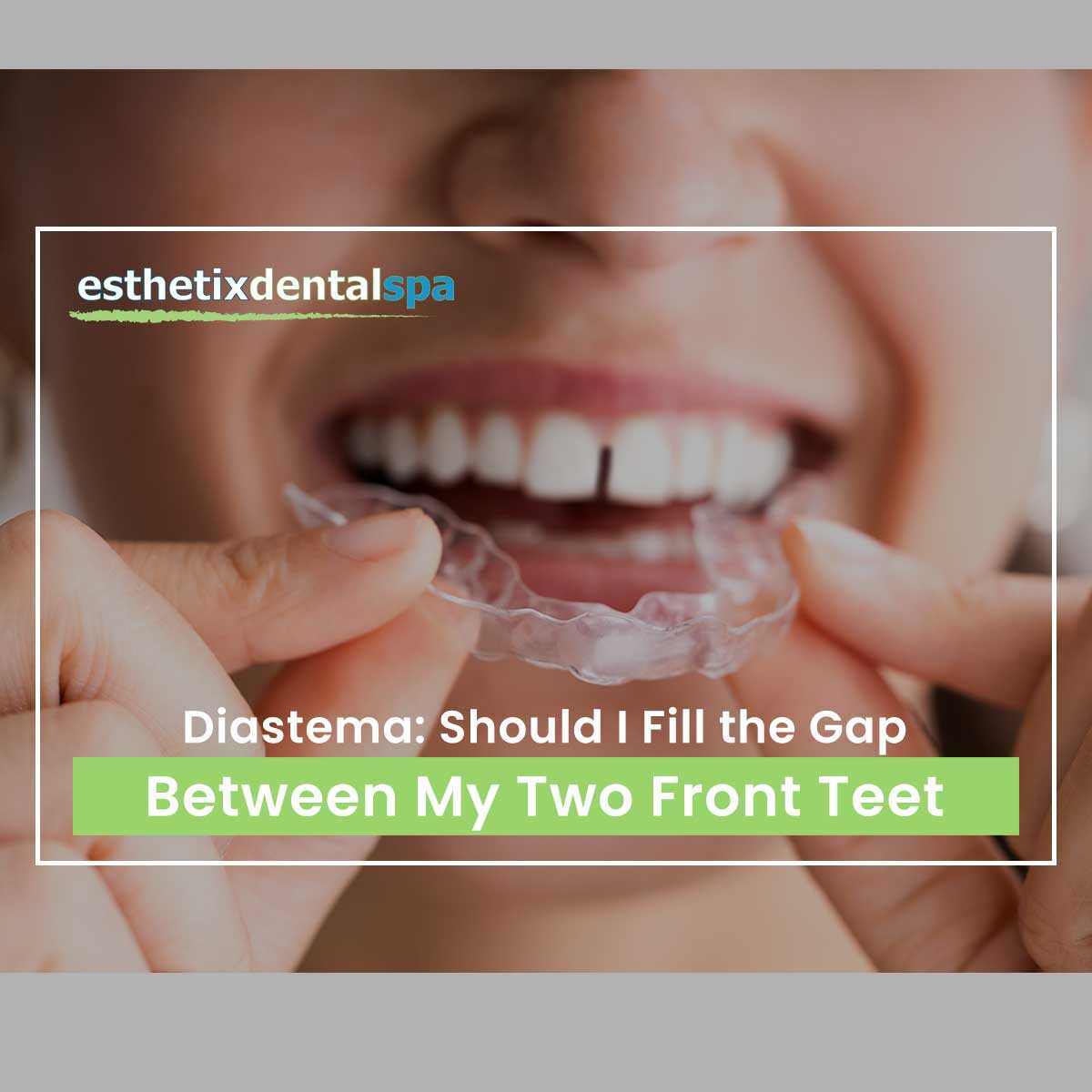 Diastema: Should I Fill The Gap Between My Two Front Teeth