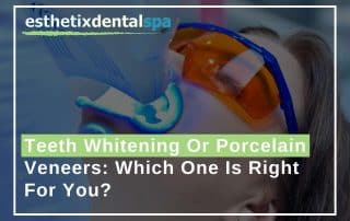 eeth-Whitening-Or-Porcelain-Veneers-Which-One-Is-Right-For-You