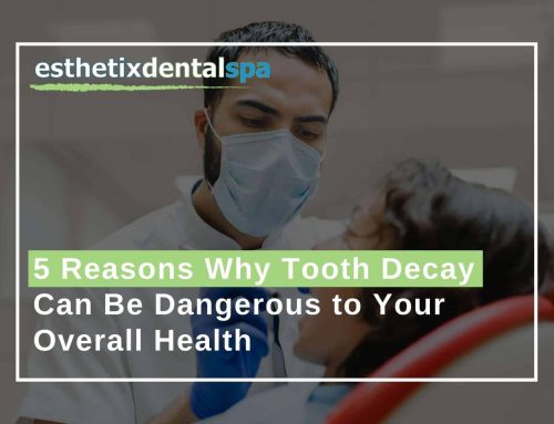 5 Reasons Why Tooth Decay Can Be Dangerous to Your Overall Health
