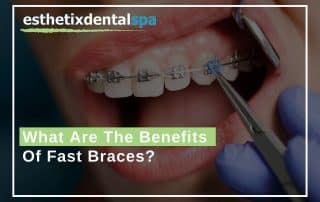 What-Are-The-Benefits-Of-Fast-Braces