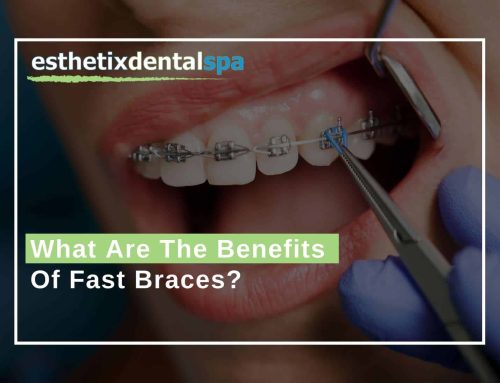 What Are The Benefits Of Fast Braces?