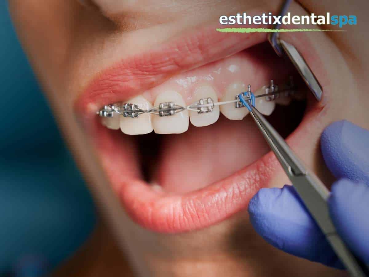 What Are The Benefits Of Fast Braces?