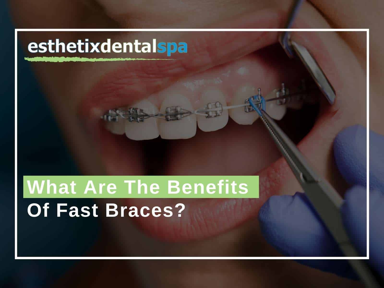 What-Are-The-Benefits-Of-Fast-Braces